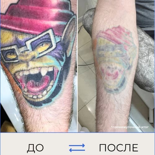 Удаление татуировки